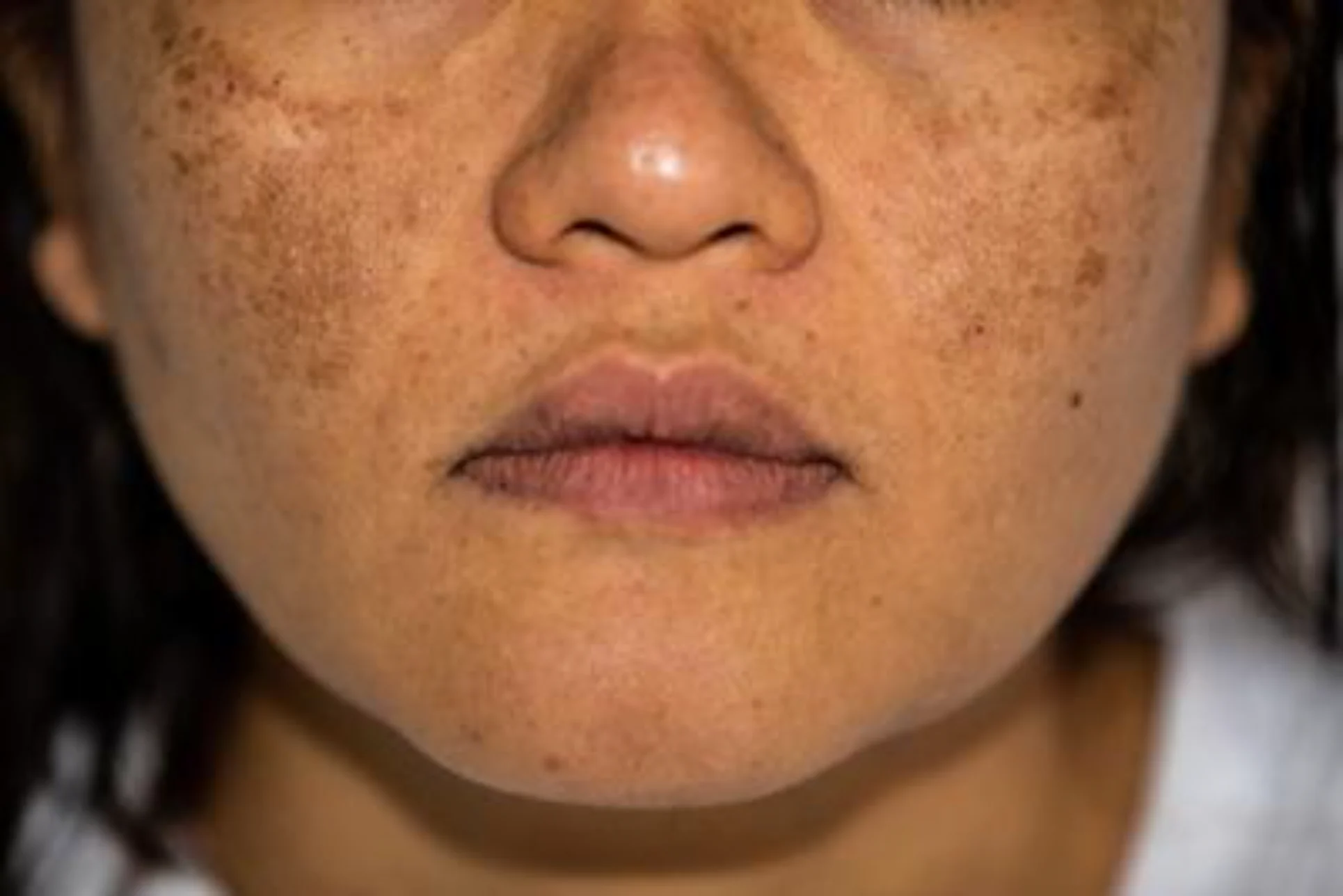 Facial hyperpigmentation care in Cortland NY